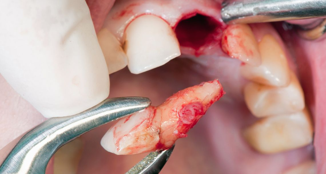 Steps-to-Take-after-Dental-Trauma-1