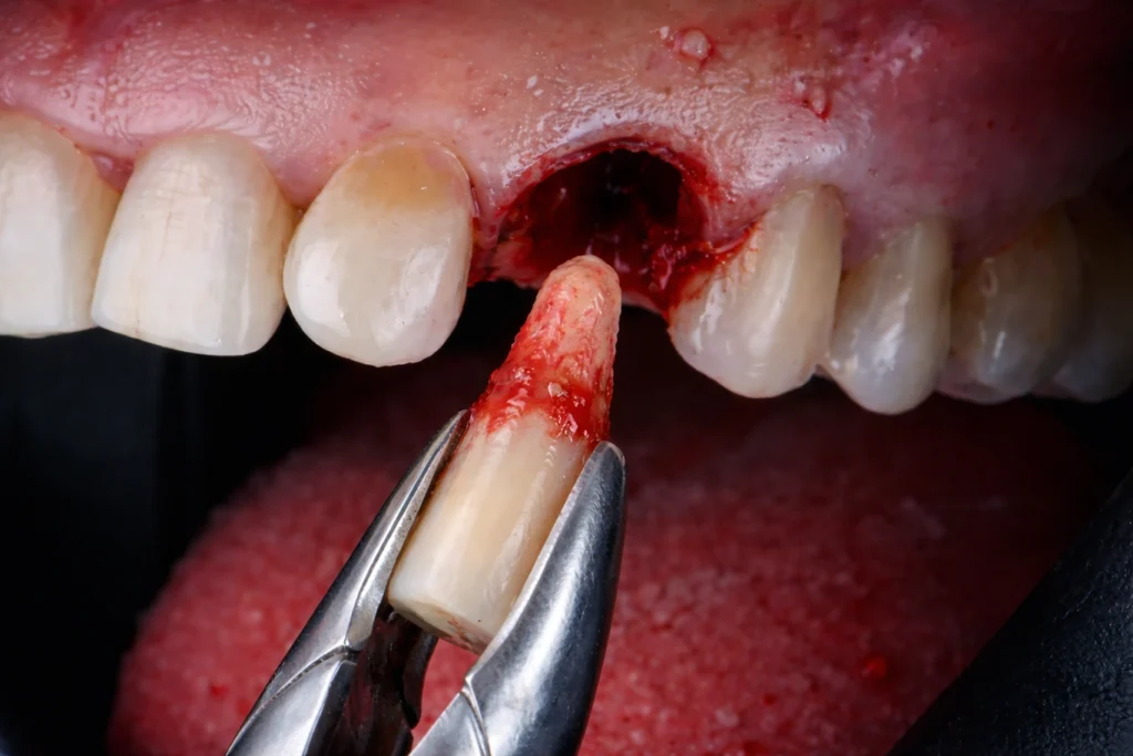 Tooth Extraction in Baldivis: What to Expect Before, During and After Treatment