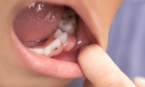 Relieving-Swelling-and-Pain-Options-in-Emergency-Dentistry
