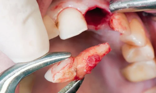 Steps-to-Take-after-Dental-Trauma-1